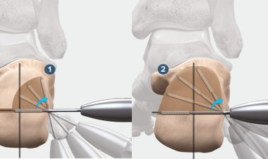 MIMCO – Minimally Invasive Medialising Calcaneal Osteotomy