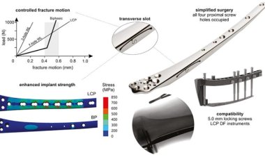 Biphasic Plate – for Distal Femur Metaphyseal Comminution