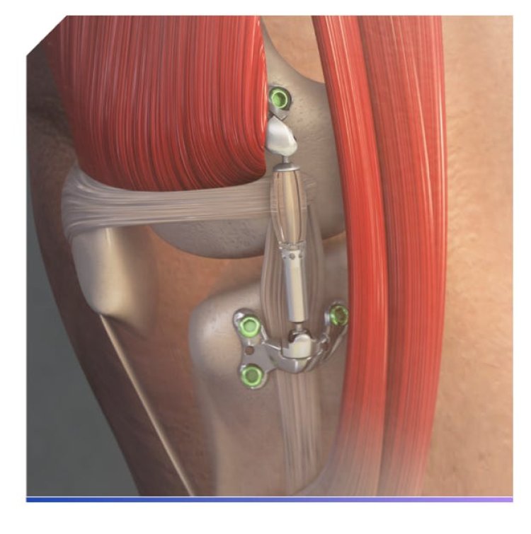 MISHA Knee System