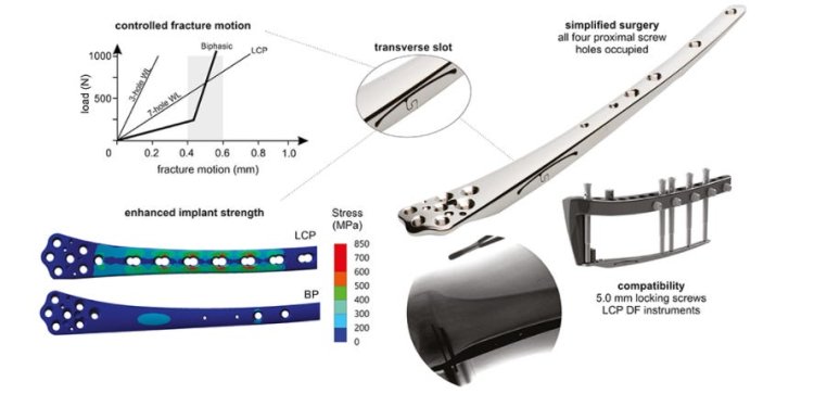 Biphasic Plate - for Distal Femur Metaphyseal Comminution